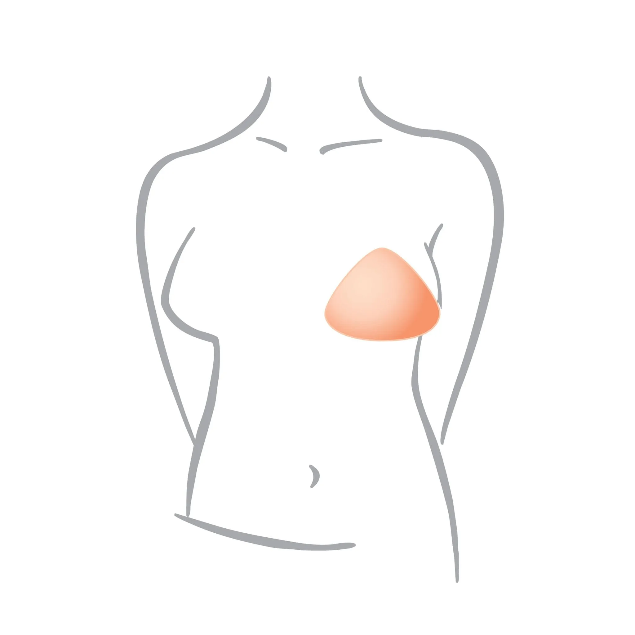 Amoena® Balance Delta Partial Breast Shaper